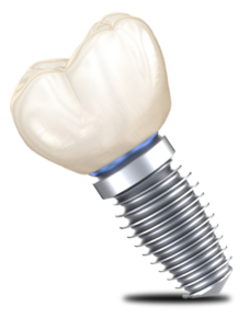 Dental Implant